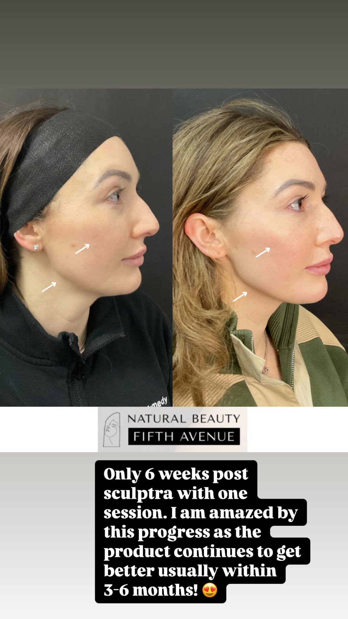 Before and after Sculptra dermal filler results: side profile comparison showing improved cheekbone and jawline definition 6 weeks post-treatment